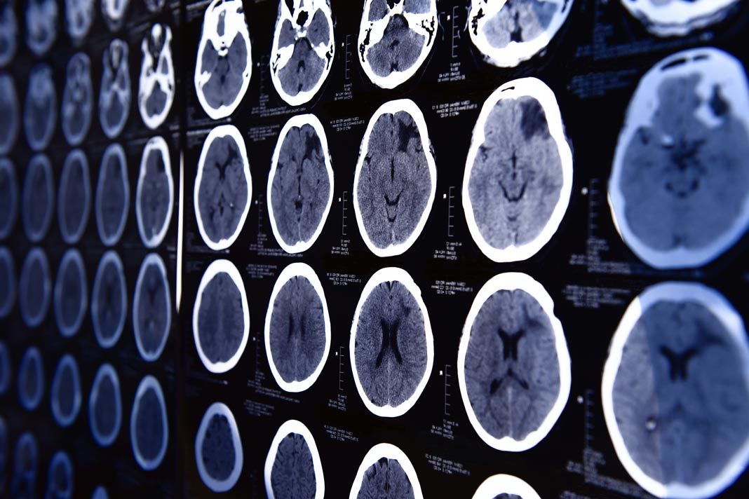 MRI