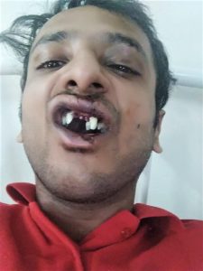 This image has an empty alt attribute; its file name is Abhishek-Mangala-lost-teeth-in-assault-by-Hindu-extremists-in-Sohna-Haryana-state-India-on-Sept.-22-2019.-Morning-Star-News-225x300.jpg