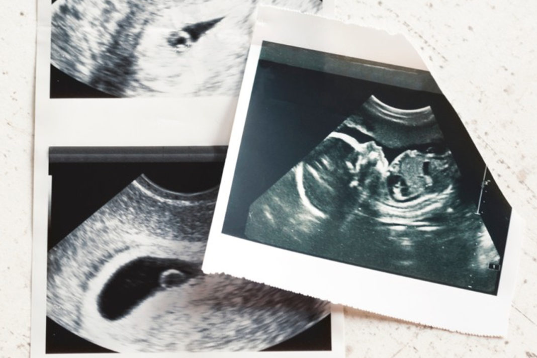 Unborn Baby