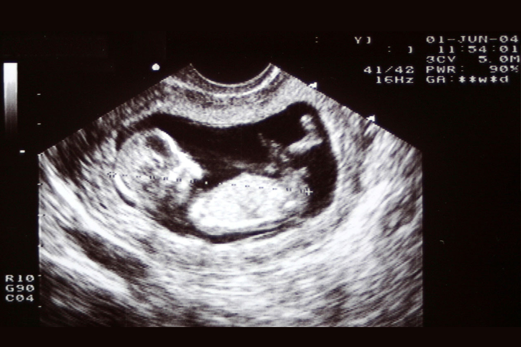 hiv-positive-and-pregnant-heres-why-you-dont-need-an-abortion Ultrasound