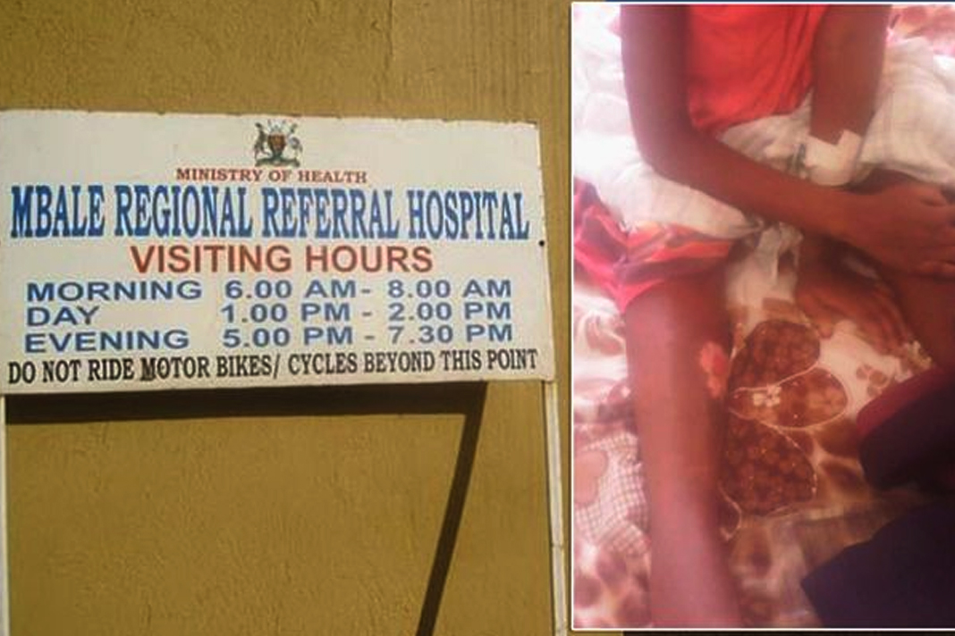 Ugandan woman's burns