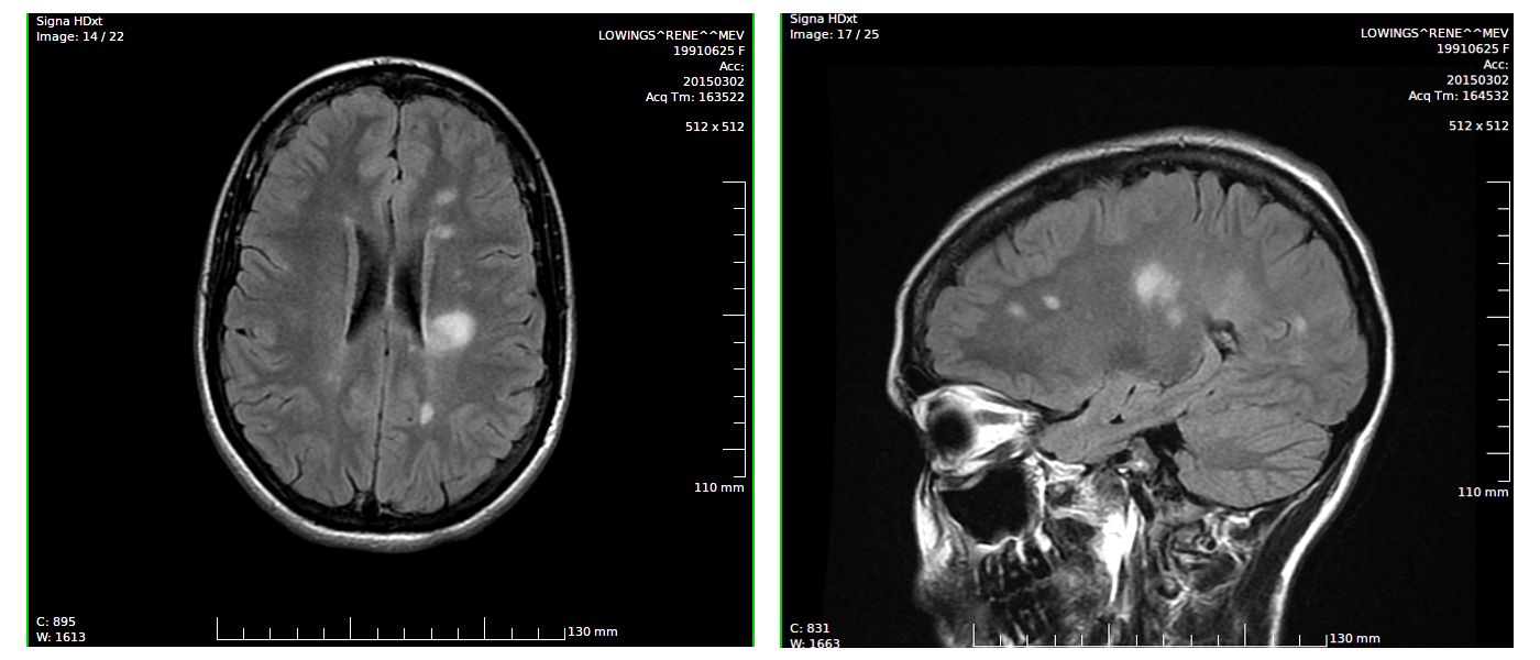 On the scans taken in 2015, the multiple sclerosis lesions are clearly visible on the left side of the brain