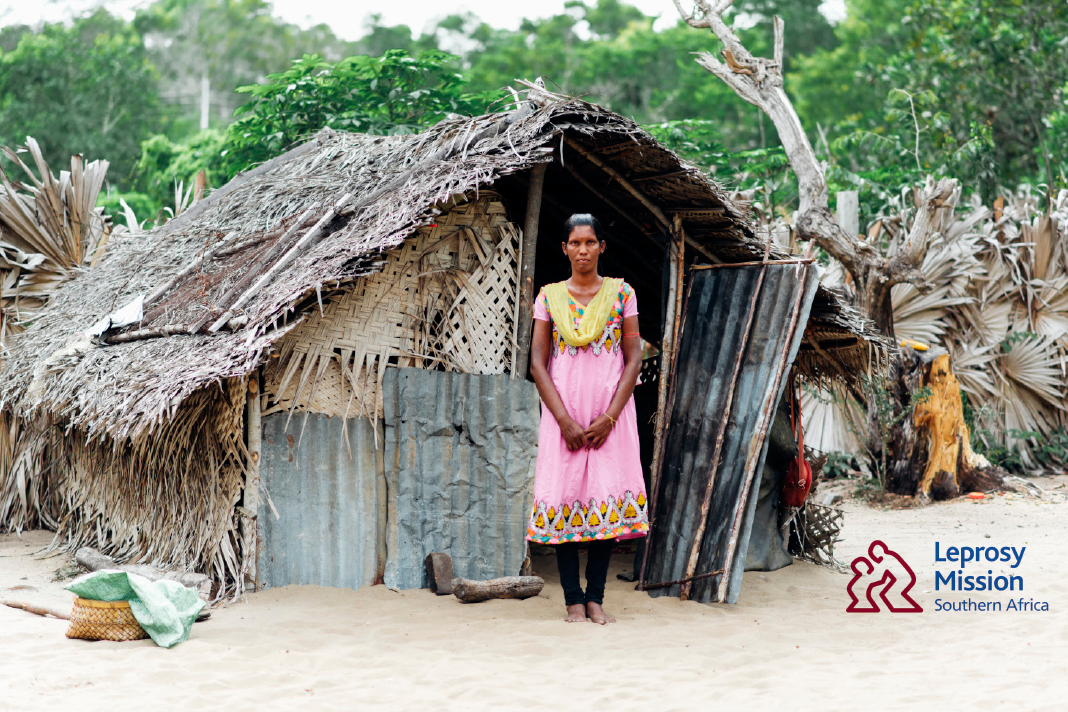 leprosy-mission-southern-africa-break-my-chains-this-christmas3